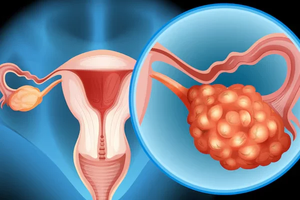 Ovarian cysts, fibroid